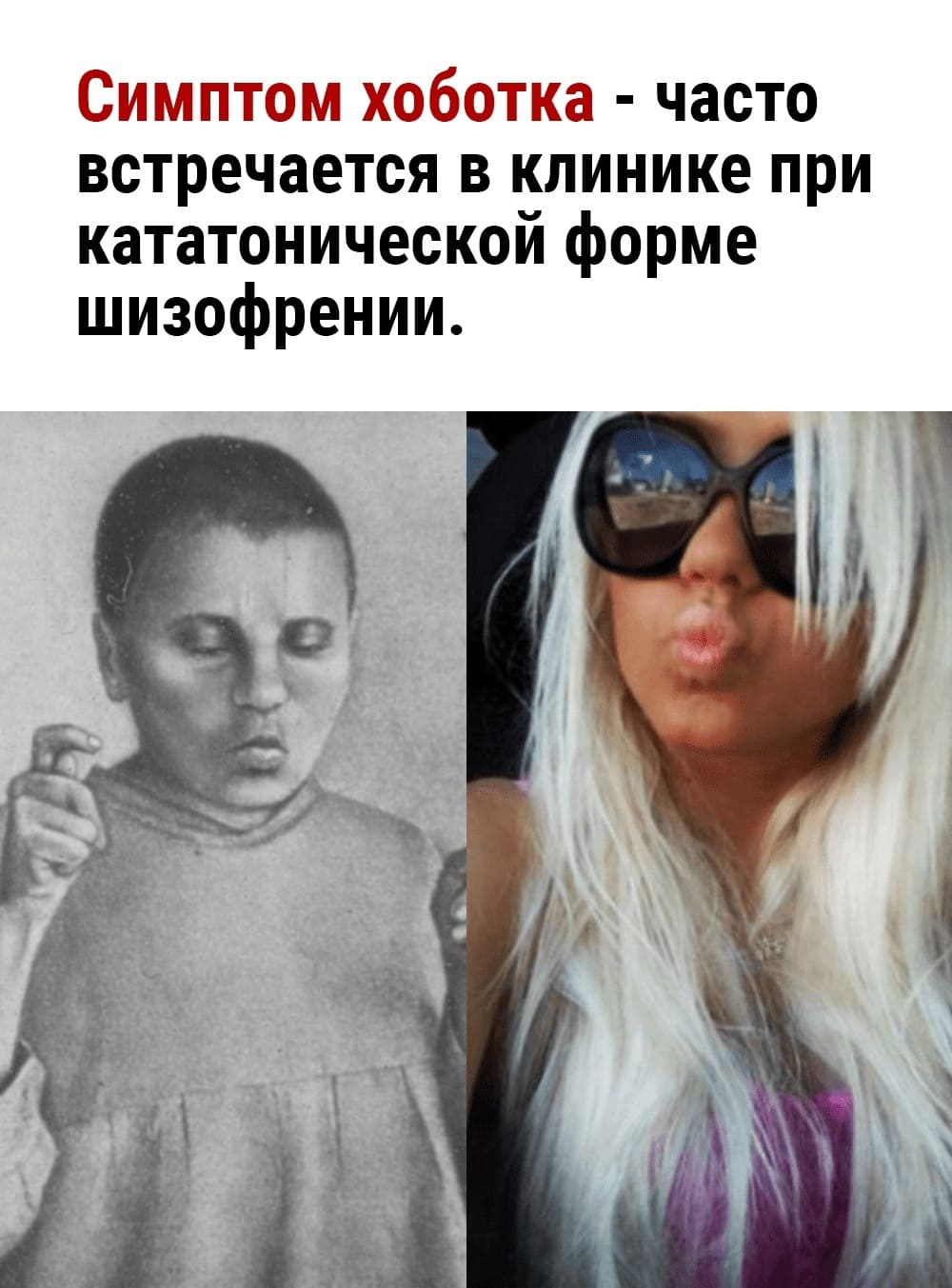 Симптом хоботка — часто встречается в клинике при кататонической форме шизофрении.