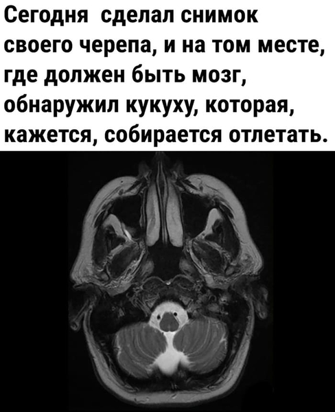 Сегодня сделал снимок своего черепа, и на том месте, где должен быть мозг, обнаружил кукуху, которая, кажется, собирается отлетать.