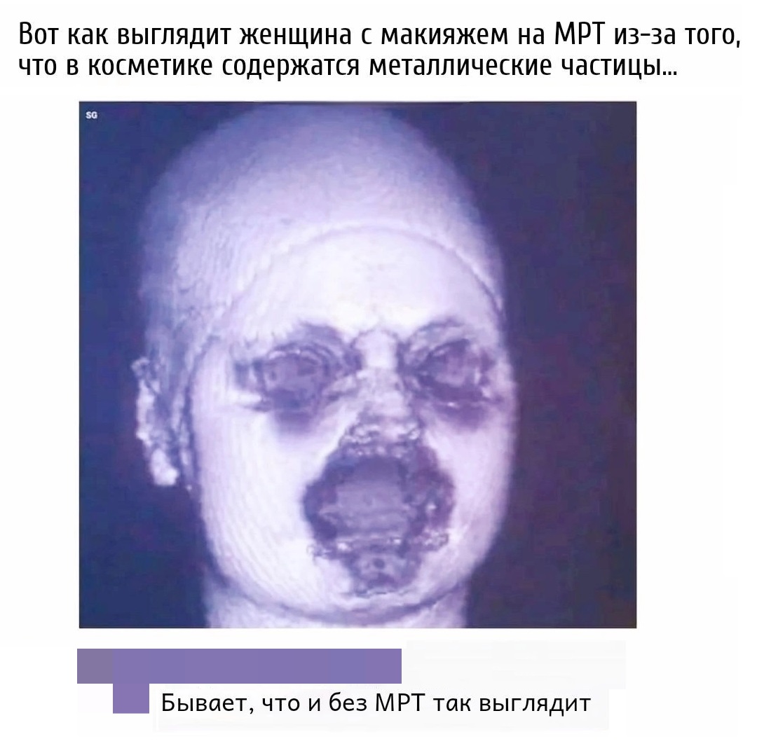 Вот как выглядит женщина с макияжем на МРТ из-за того, что в косметике содержатся металлические частицы...
– Бывает, что и без МРТ так выглядит...