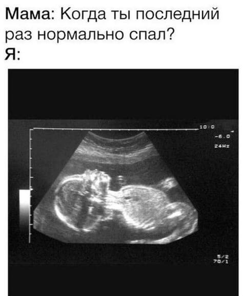 Мама: Когда ты последний раз нормально спал?
Я: *Снимок УЗИ*