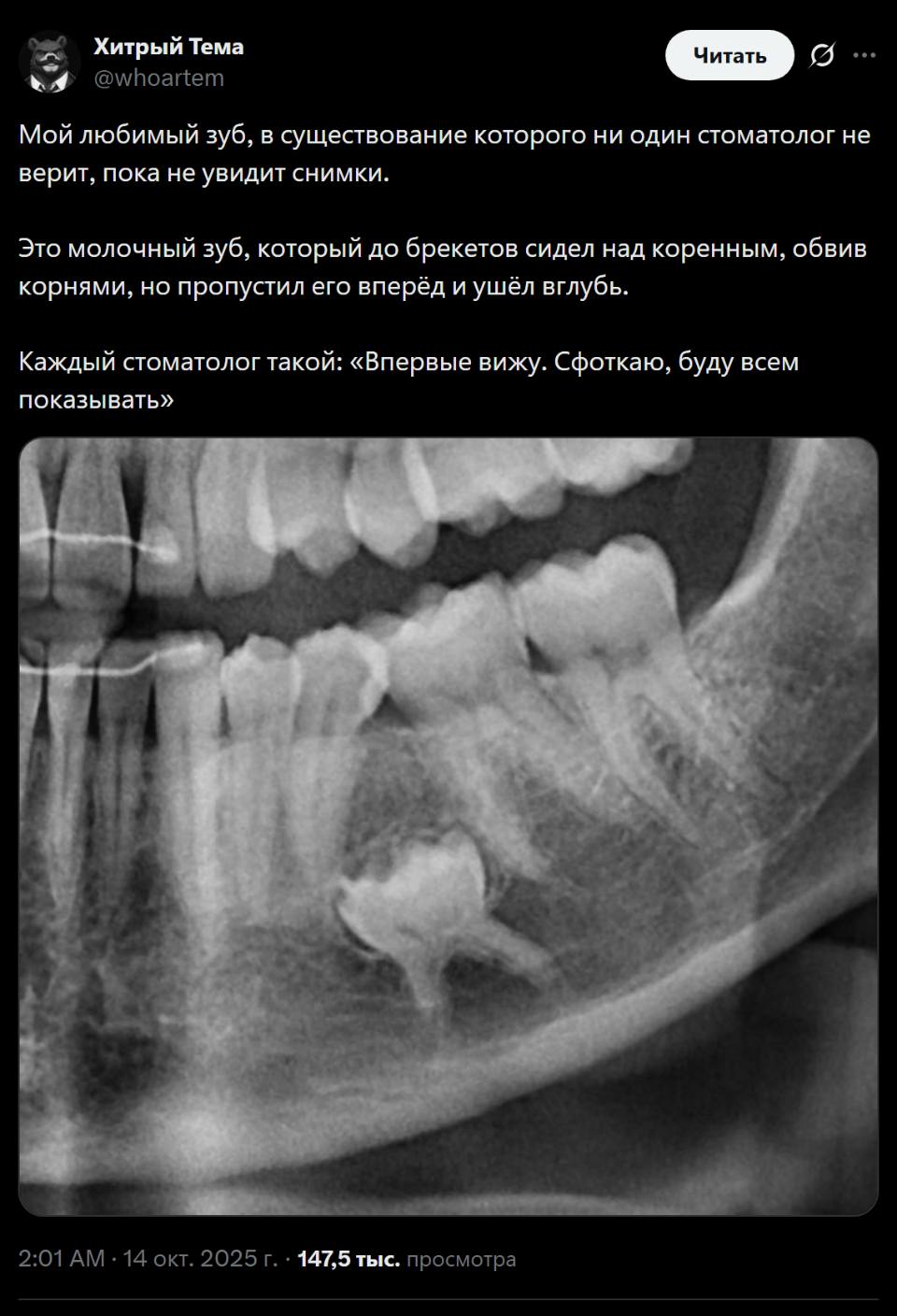 Мой любимый зуб, в существование которого ни один стоматолог не верит, пока не увидит снимки. Это молочный зуб, который до брекетов сидел над коренным, обвив корнями, но пропустил его вперёд и ушёл вглубь. Каждый стоматолог такой: «Впервые вижу. Сфоткаю, буду всем показывать».