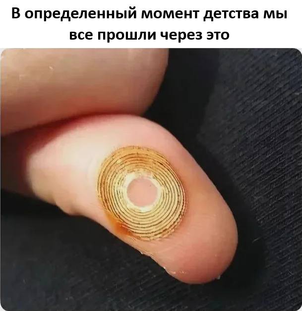 *В определенный момент детства мы все прошли через это*
*Ожёг на пальце от автомобильного прикуривателя*