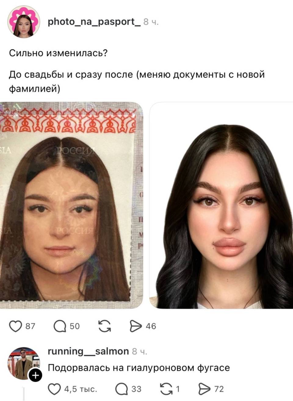 – Сильно изменилась? До свадьбы и сразу после (меняю документы с новой фамилией).
– Подорвалась на гиалуроновом фугасе.